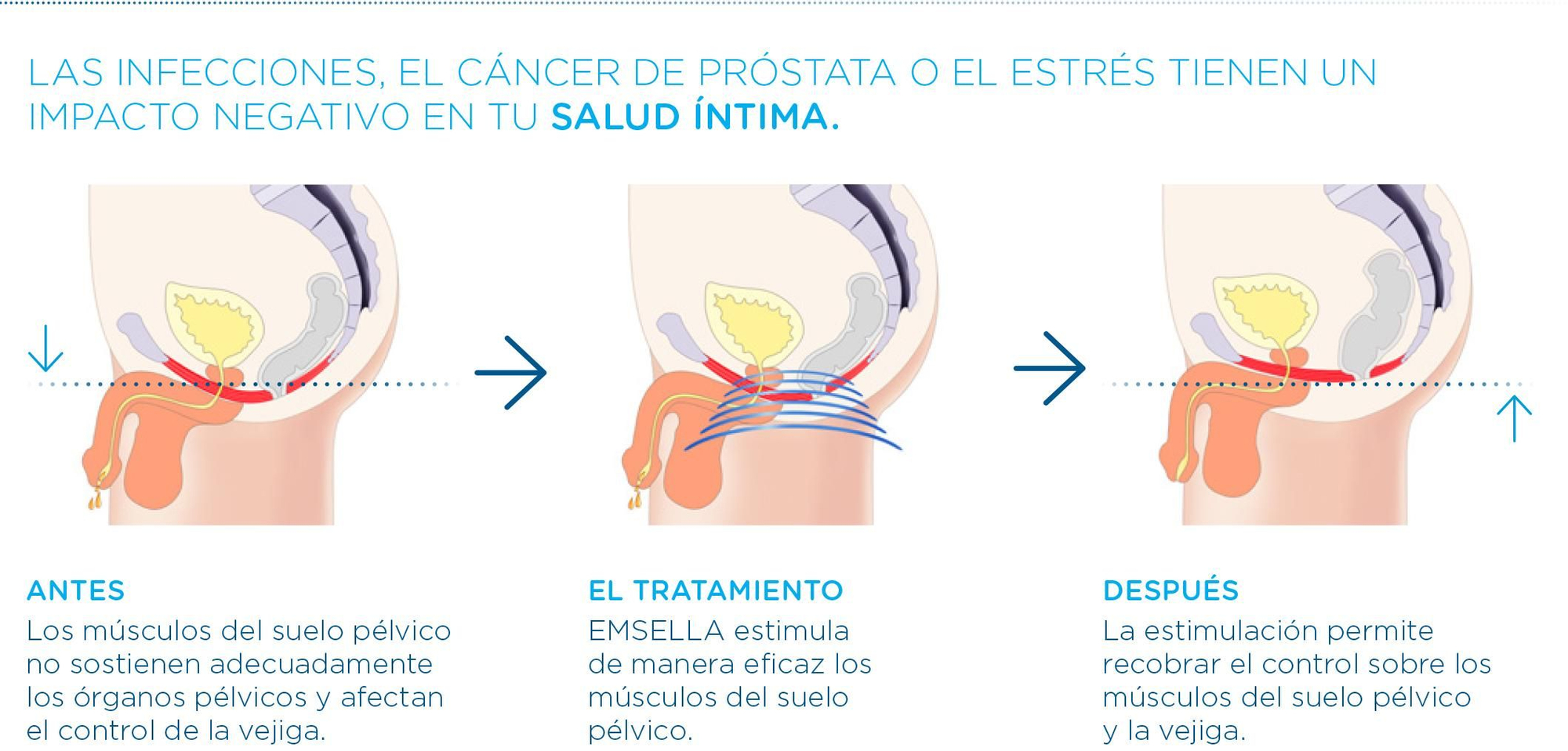 Corte sagital suelo pélvico hombre.