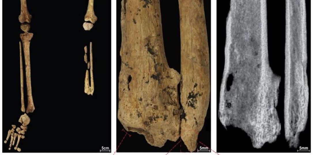 A) Piernas izquierda y derecha con cintura pélvica que muestran la ausencia completa de la parte inferior de la pierna izquierda. B) Tibia y peroné izquierdos que muestran la superficie de atrofia y necrosis. C) Radiografía de la tibia y el peroné izquierdos