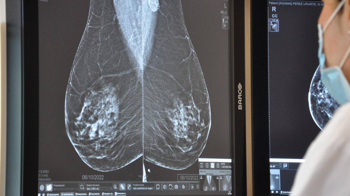 Un radiólogo, sobre la radiación de las mamografías: “Equivale a un vuelo transoceánico y nadie deja de viajar a Nueva York por ello”