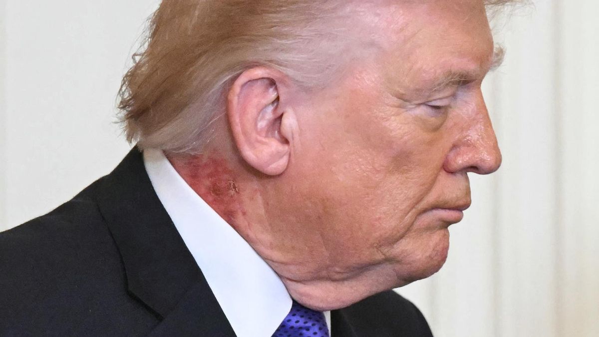 La llamativa herida de Trump en el cuello: la Casa Blanca dice que tiene que ver con una crema para la piel, pero no dice para qué la usa
