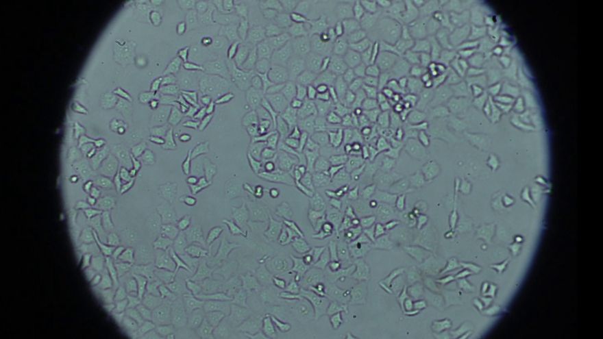 Un avance en el cáncer de páncreas para que la quimioterapia penetre de forma más efectiva