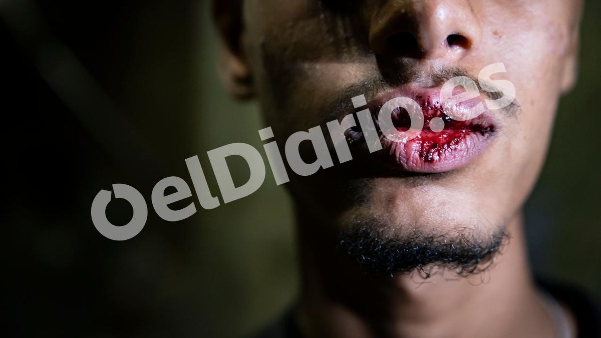 Un joven con heridas en la boca tras una agresión de la que acusa a militares desplegados en Ceuta.