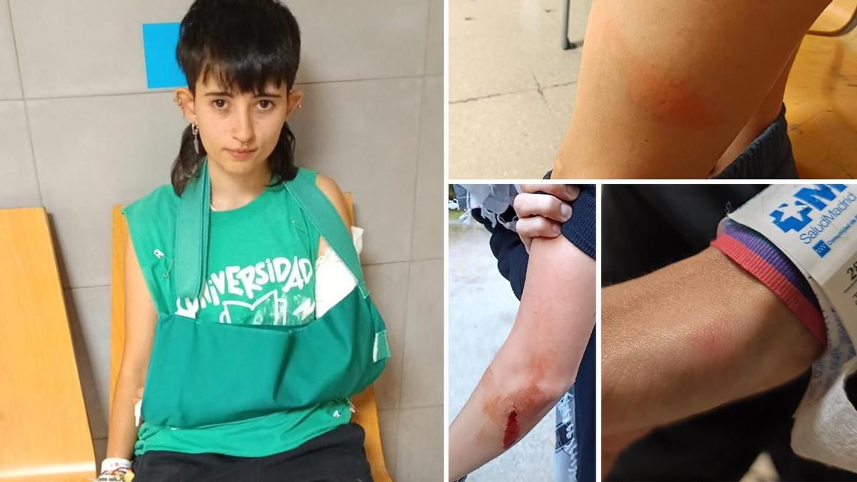Una estudiante herida en las protestas de la Complutense denunciará a la Policía por romperle el cúbito: «He puesto el brazo, pero iba a la cara»