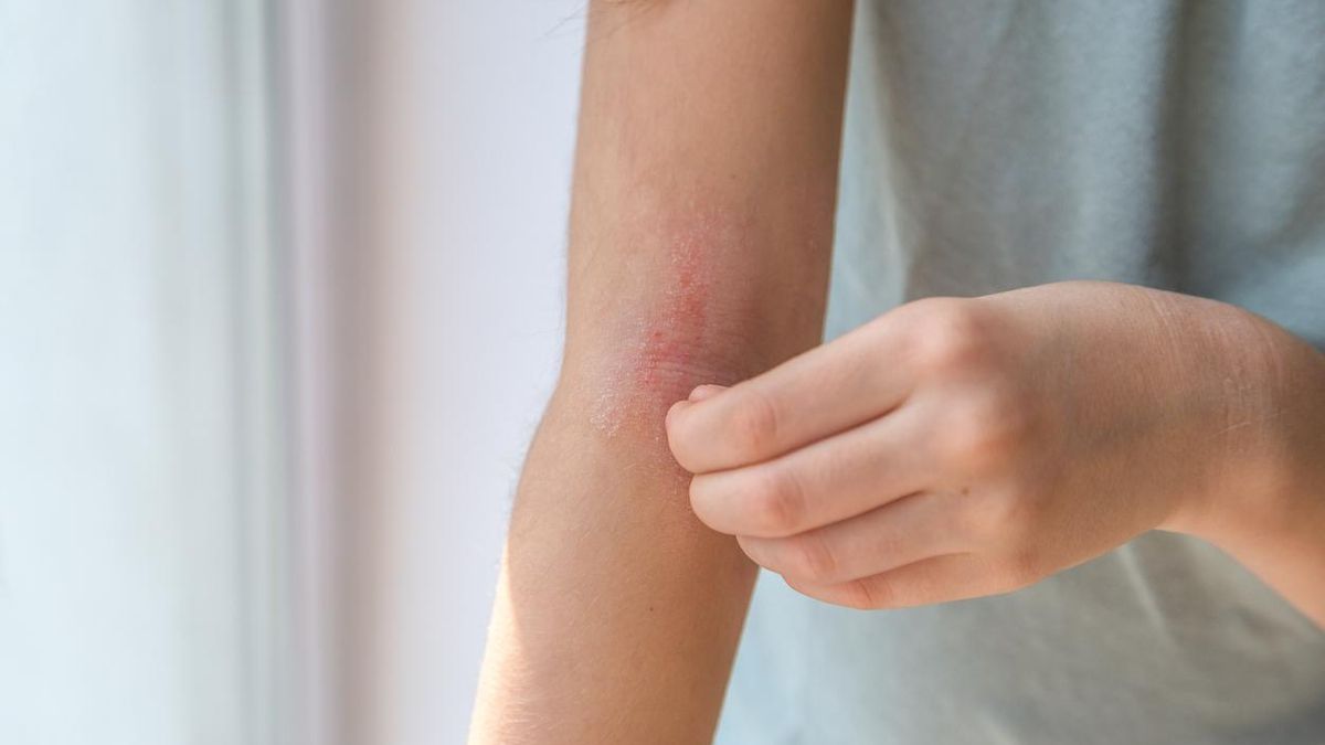 Dermatitis atópica, ¿una enfermedad solo de la piel?