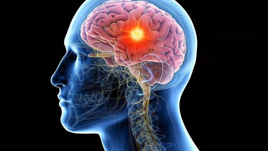 Ilustración de un tumor cerebral. // Universidad de Sevilla