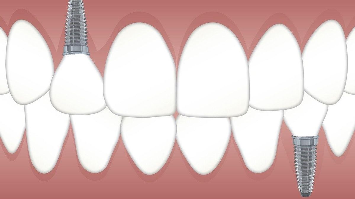 Tipos de implantes dentales: cómo saber cuál es el mejor para nosotros
