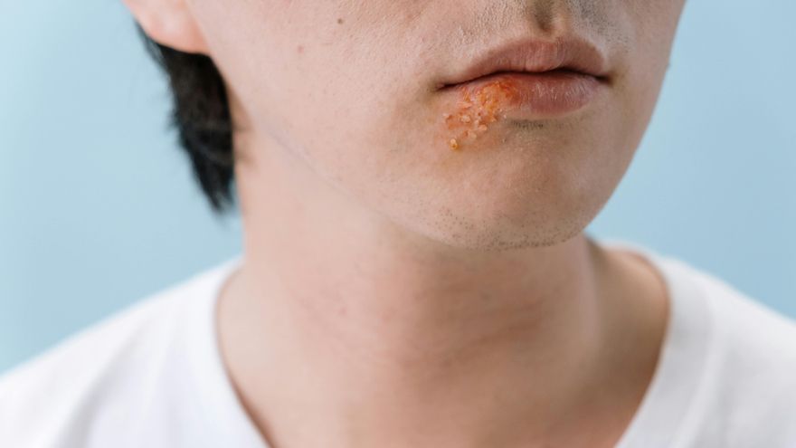Un megaestudio asocia el herpes labial con un mayor riesgo de desarrollar alzhéimer