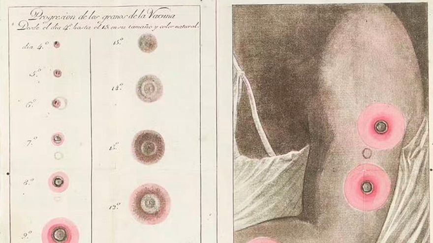Una imagen de las pústulas de la viruela e indicaciones sobre la vacuna.