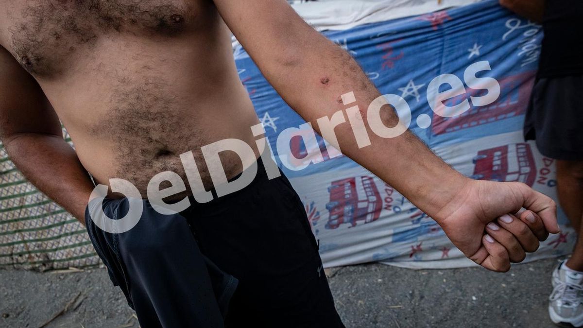 El brazo de Bilal cubierto de quemaduras de cigarro.