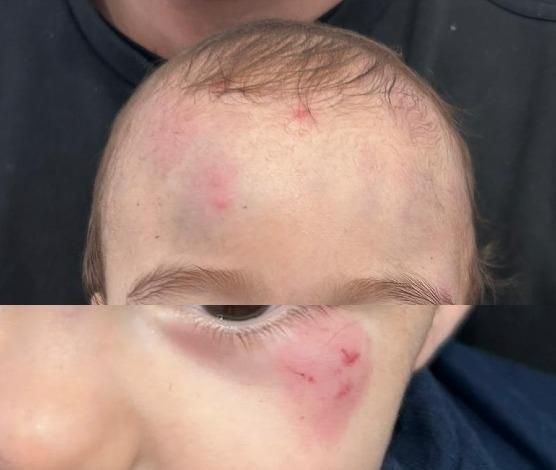 Imagen aportada por la defensa de la familia con algunas lesiones del menor