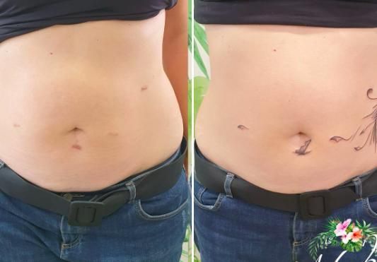 Tatuaje para camuflar cicatrices