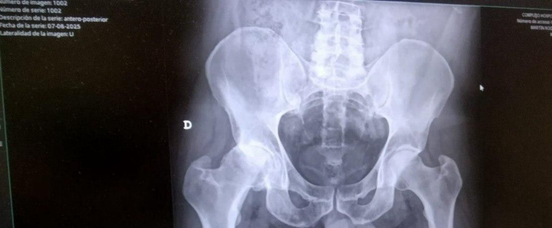Radiografía que muestra la coxartrosis severa de cadera derecha (izquierda en la imagen) de Pedro en agosto de 2025.