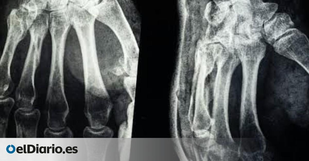 Un gel desarrollado en China ensaya una técnica para soldar huesos en apenas tres minutos