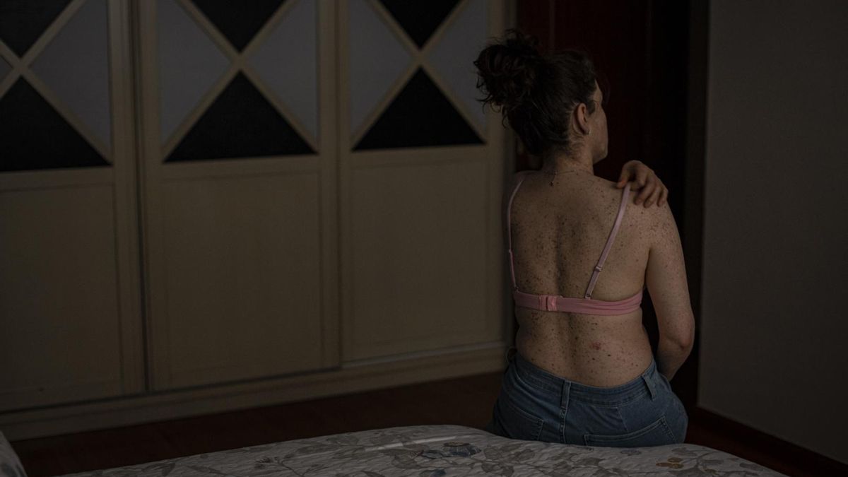 Susana, de 34 años, sentada en el costado de su cama (Zaragoza) mientras enseña la cantidad de pecas que tiene en la espalda