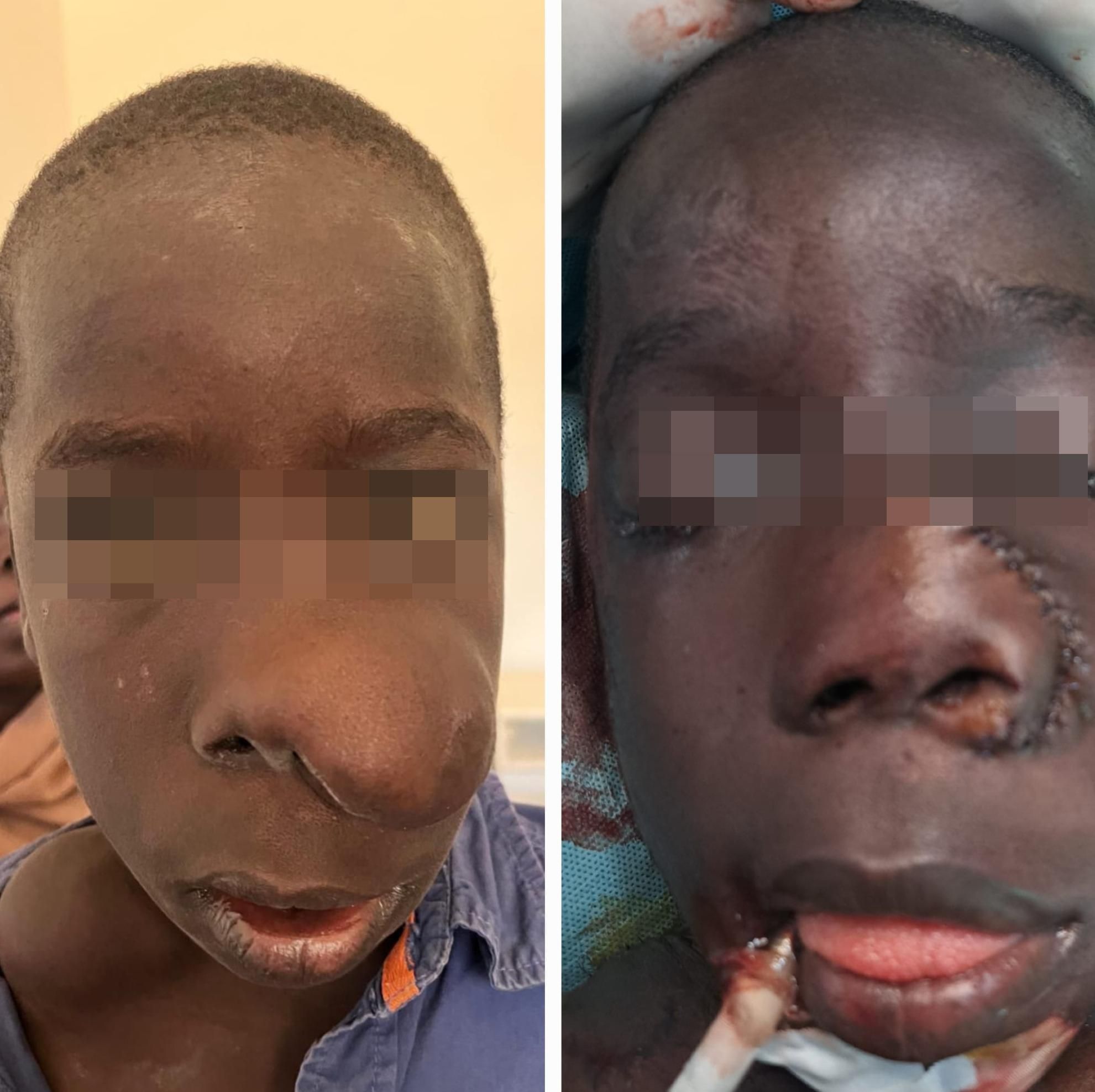 Un nen de 13 anys amb neurofibromatosi després de ser sotmès a una exèresi i plàstia nasal.