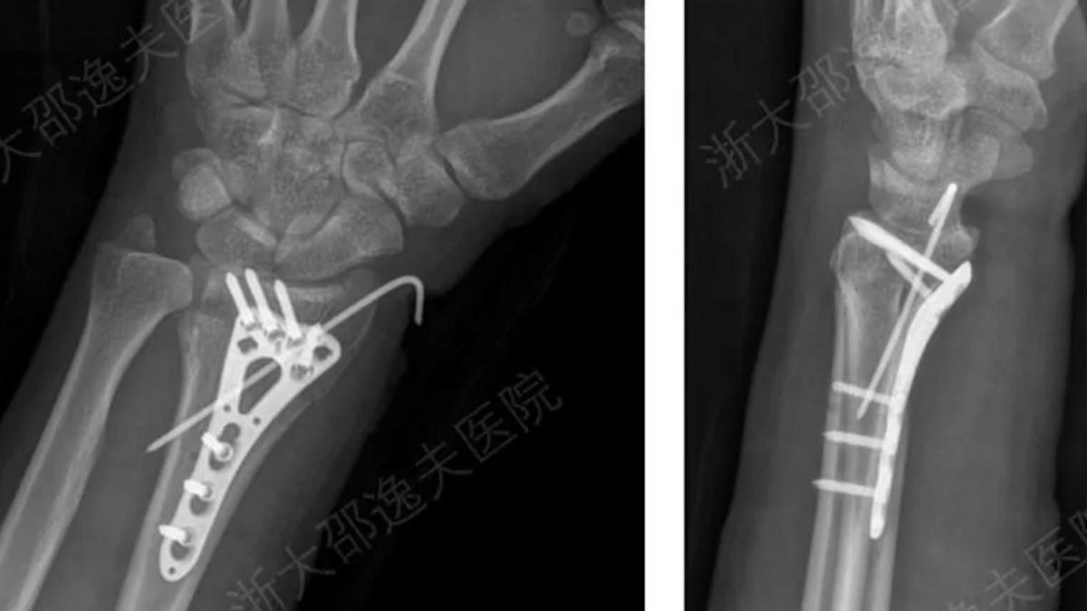 Las pruebas clínicas mostraron que el adhesivo soporta grandes esfuerzos físicos
