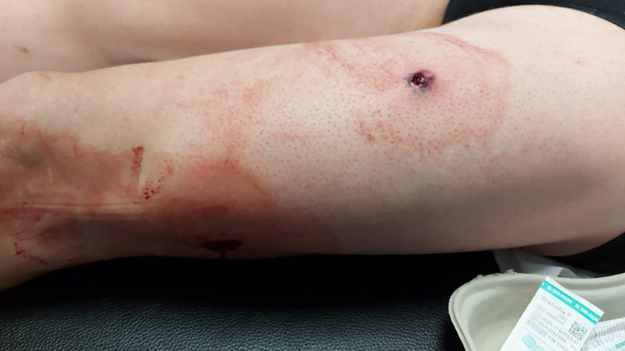 Herida de bala del guardia civil que fue disparado. AUGC Las Palmas