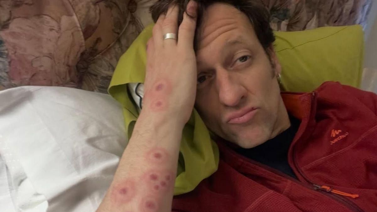 Edu Soto actualiza su estado de salud y muestra el problema en su piel que le llevó al hospital: "Picores inimaginables"