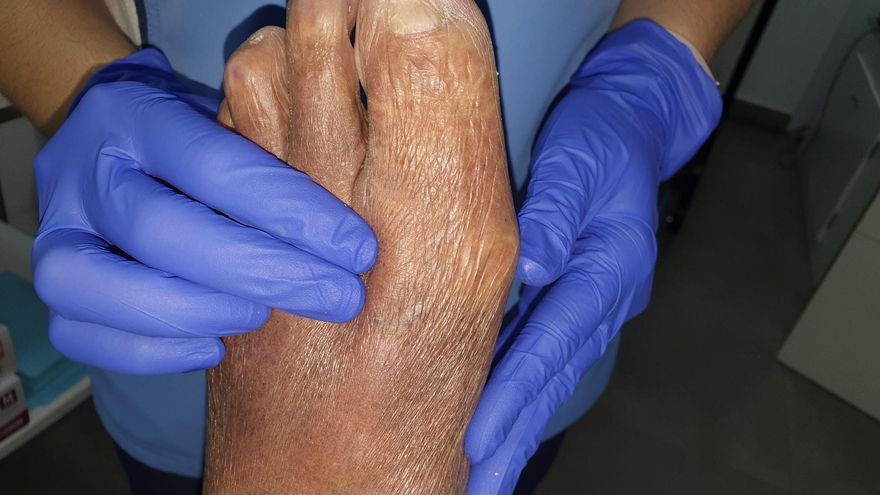 Los podólogos piden unidades de atención del pie diabético en Castilla-La Mancha por el aumento de su incidencia