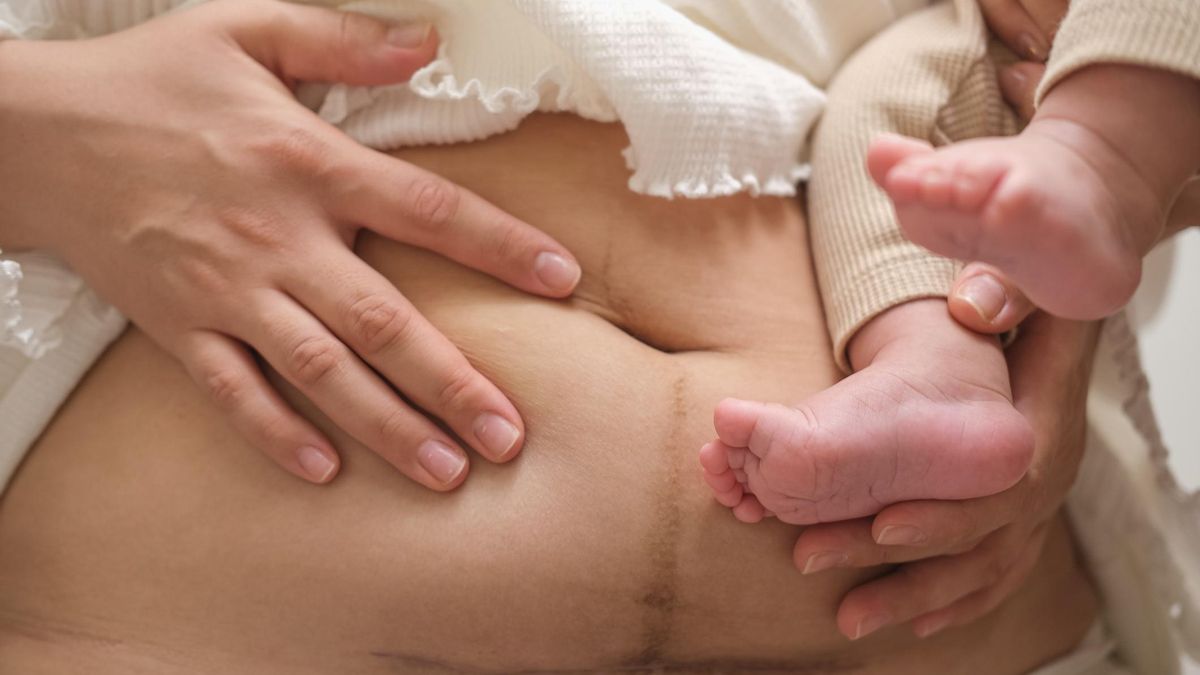 Cicatriz de una cesárea