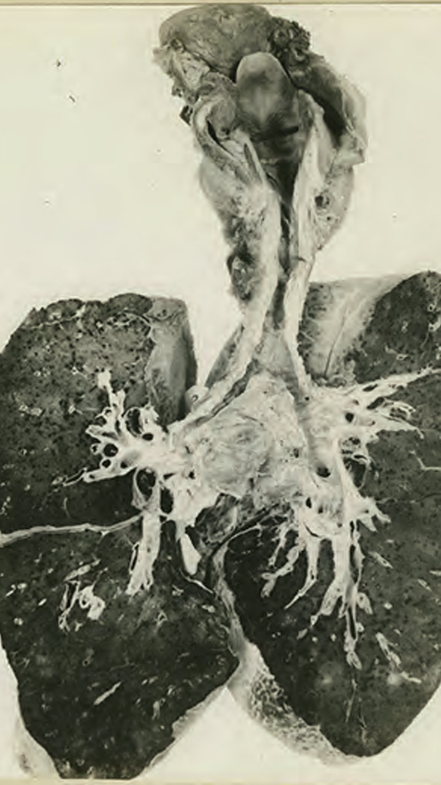 Primera Guerra Mundial: Unos pulmones muestran una estenosis en la tráquea tras la inhalación de gas mostaza. Foto realizada el 12 de enero de 1919.