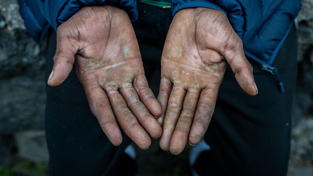 Las manos de uno de los supervivientes del vuelco del cayuco de El Hierro.
