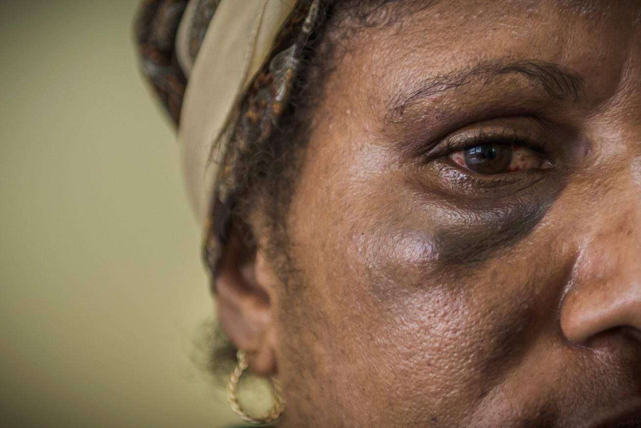 La violencia familiar y sexual, en particular contra las mujeres y los niños, es demasiado común en el país. Cathy, 34 años, acude a consulta en el Centro de Apoyo Familiar en Port Moresby tras sufrir una agresión por parte de su pareja. Fotografía: Yann Libessart/MSF