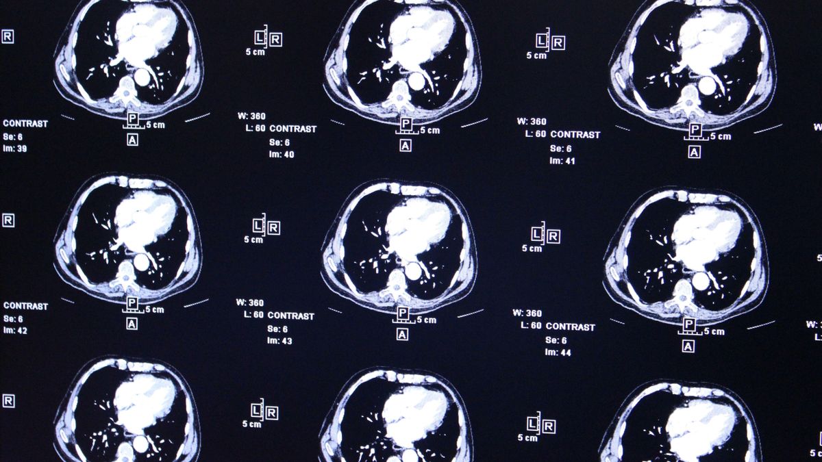 Crean la escala de riesgo genético de alzhéimer más completa hasta la fecha