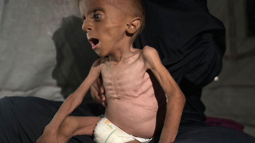 Seis nuevos gazatíes mueren por desnutrición, dos de ellos niños