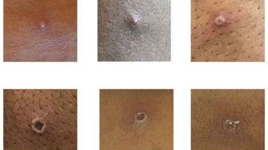 Biden dijo que la viruela del mono "debería preocupar a todo el mundo"