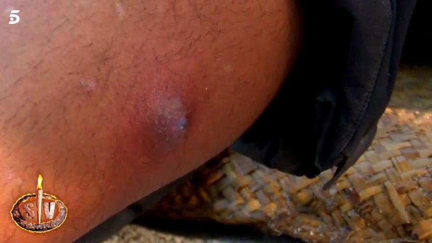 La pierna de Gianmarco tras la picadura de araña