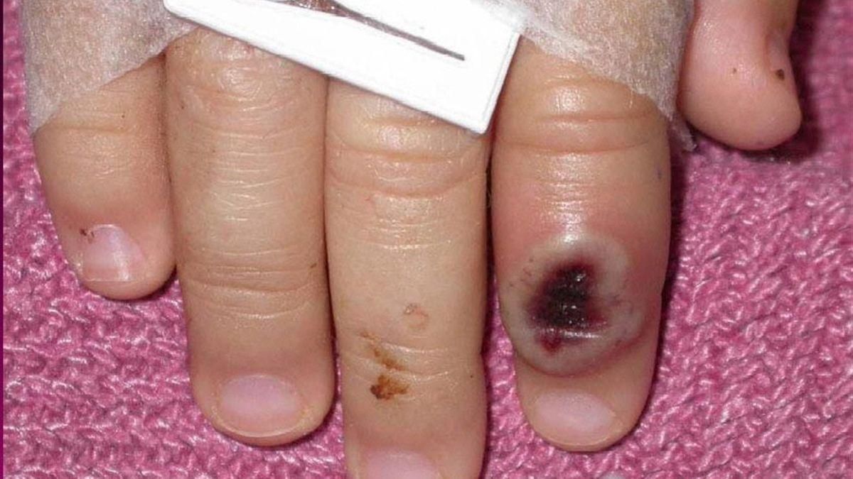 Fotografía de archivo del Centro Estadounidense de Control de las Enfermedades (CDC) en la que se aprecia el dedo de un niño infectado por la "viruela de mono".