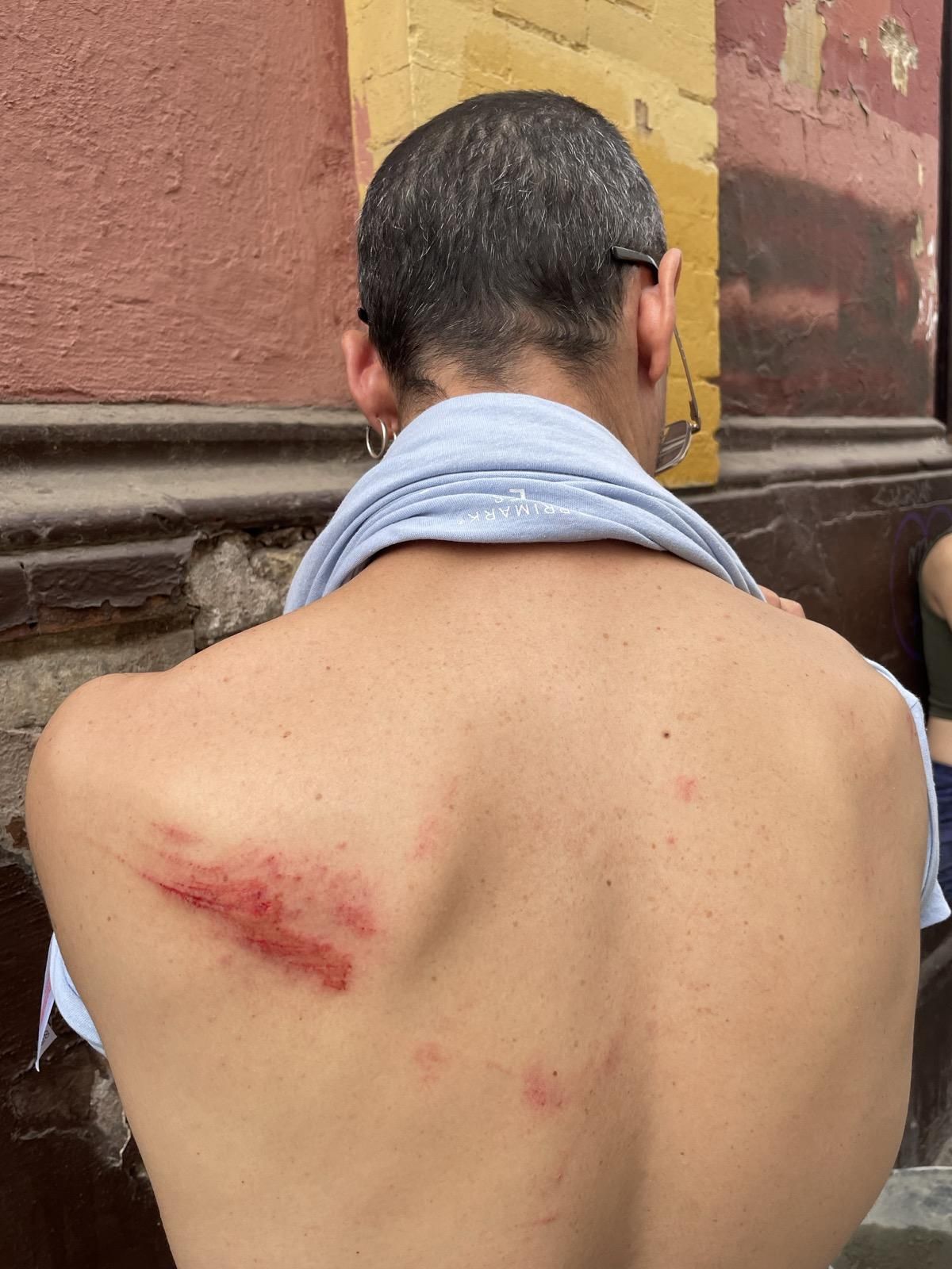 Uno de los heridos muestra las señales que le ha dejado en la espalda este último asalto.
