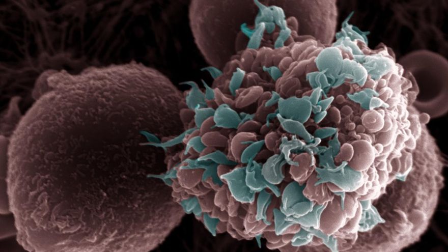 Un estudio en ratones prueba que una dieta grasa favorece la metástasis del cáncer de mama