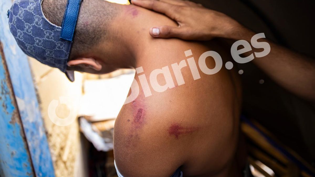 Un joven marroquí muestra las lesiones que, asegura, fueron provocadas por militares que lo retuvieron ilegalmente al bosque próximo al CETI donde dneuncia que le dieron una paliza con las porras.
