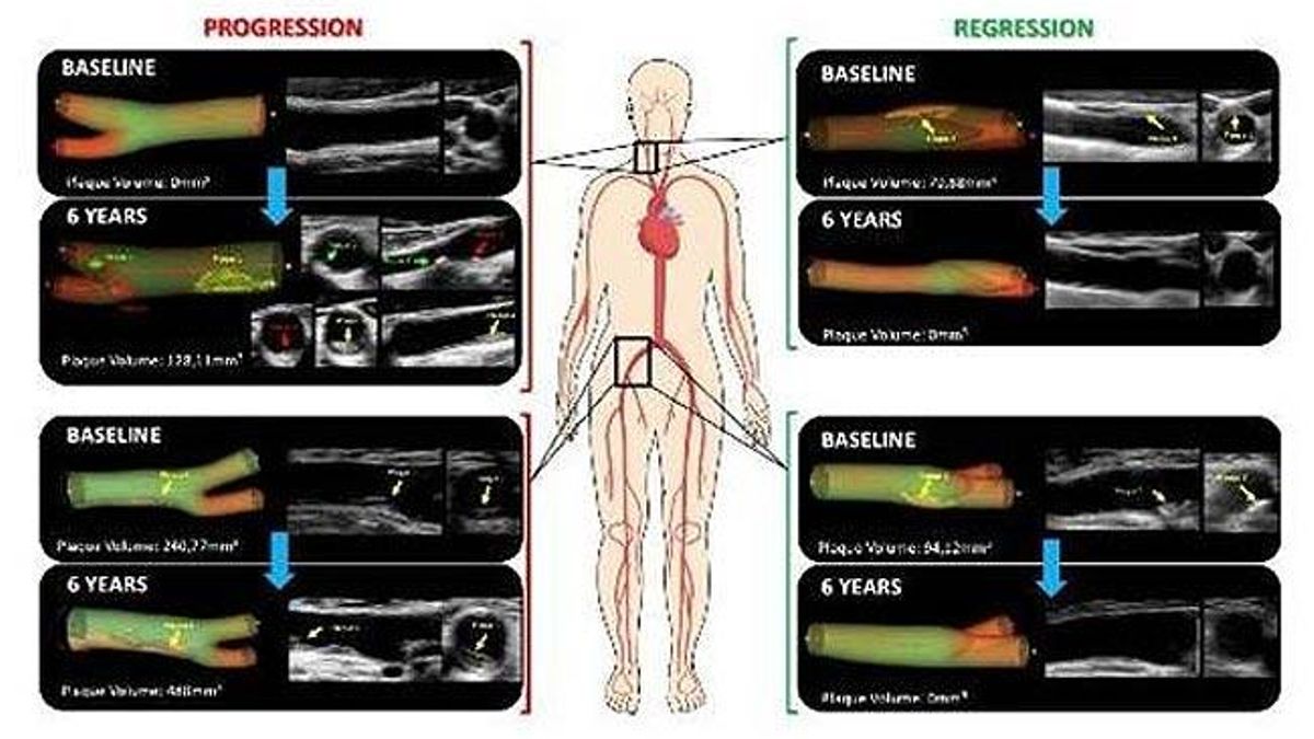 Casos de progresión de aterosclerosis (izquierda) y de regresión (desaparición de la misma, derecha) en arterias carótidas (en el cuello) en las femorales (ingles).