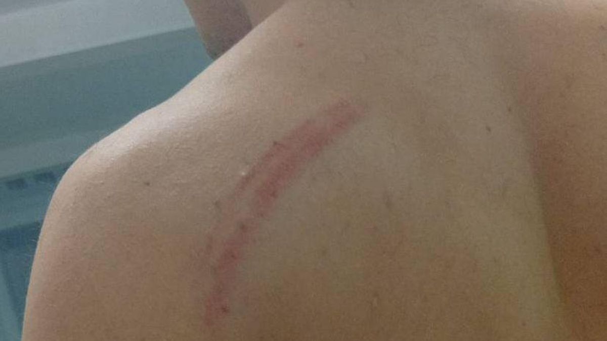 Marcas de porrazos en el cuerpo de un manifestante
