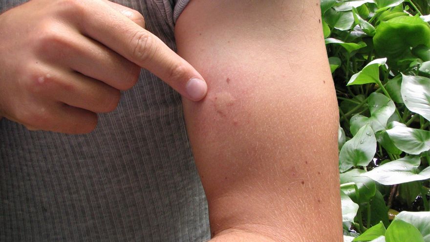 Del mosquito a la araña: cómo son las principales picaduras del verano