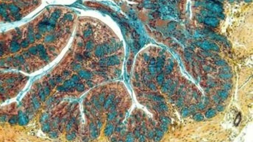 Describen una nueva terapia para la enfermedad inflamatoria intestinal