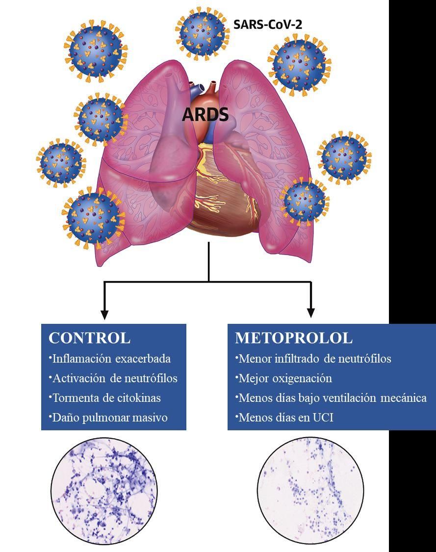 El metoprolol, un fármaco beta-bloqueante tradicional, tiene un efecto muy selectivo sobre el neutrófilo hiperactivado.