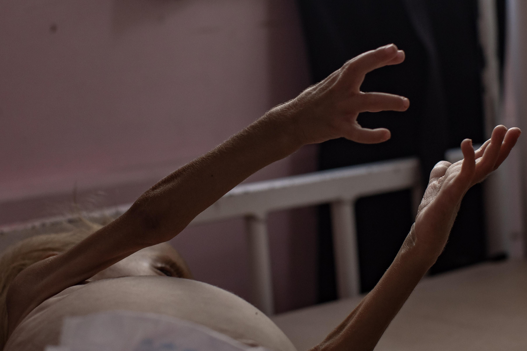 Sham Qudeih, un niño palestino de dos años, desnutrido en una cama en el Hospital Nasser en Gaza el 11 de agosto.