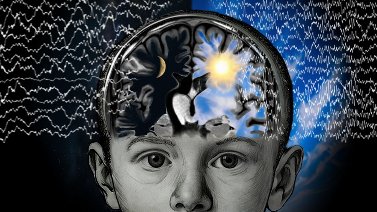 Recreación artística del cerebro dividido en los niños sometidos a cirugía por epilepsia grave.
