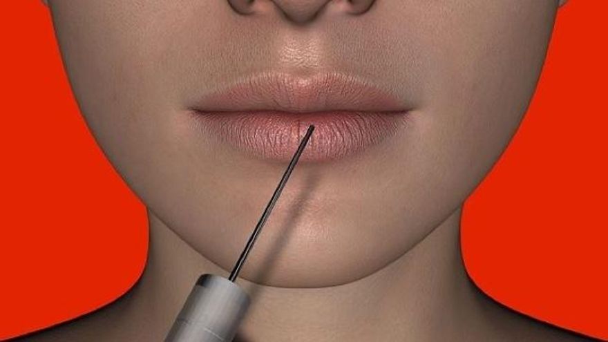 Bótox en adolescentes, una tendencia que no deja de aumentar