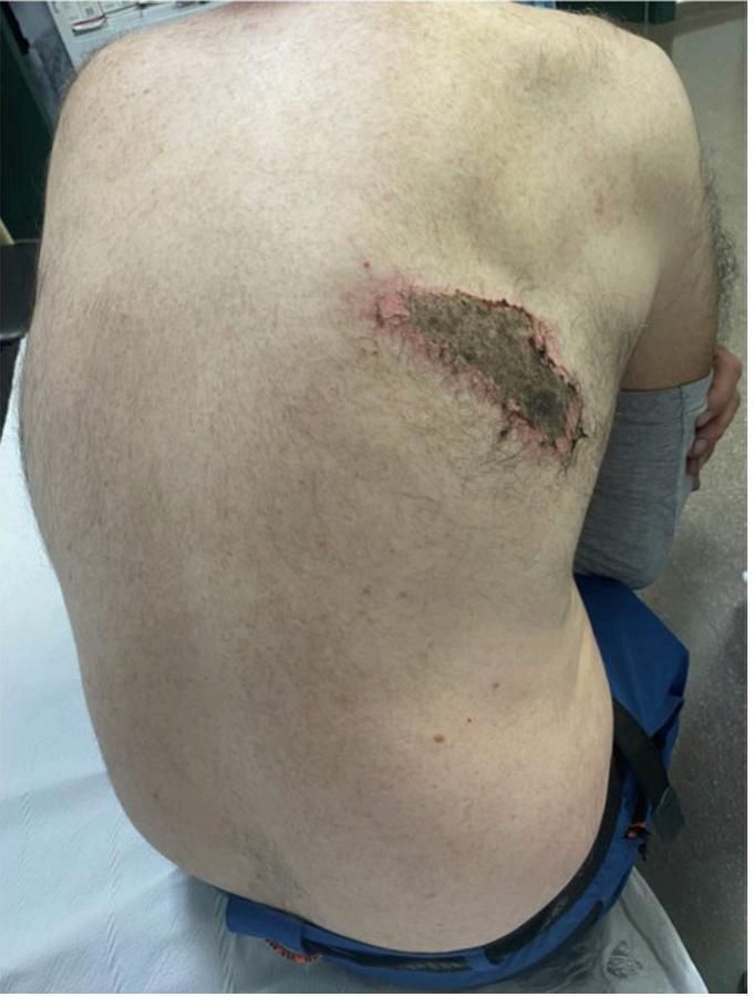 Herida tras picadura de Vespa velutina hacía 6 horas
