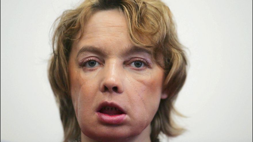 Los trasplantes de cara prometían esperanza pero los pacientes han sufrido un calvario