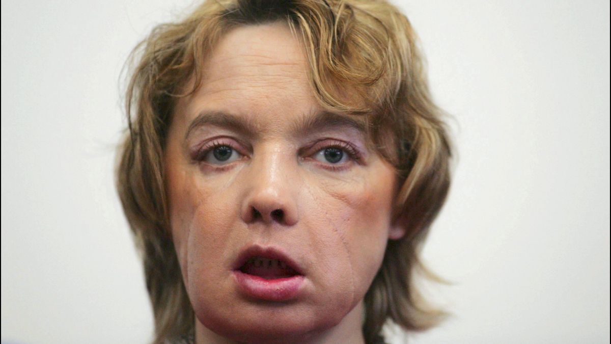 Los trasplantes de cara prometían esperanza pero los pacientes sufren un calvario