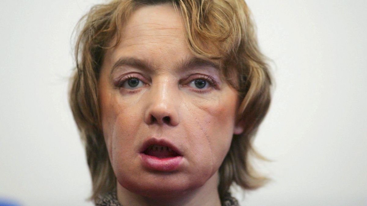 Los trasplantes de cara prometían esperanza pero los pacientes han sufrido un calvario