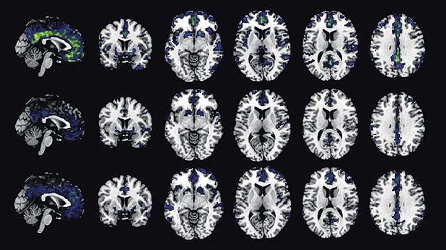 La vacuna recombinante contra el virus del herpes reduce el riesgo de demencia