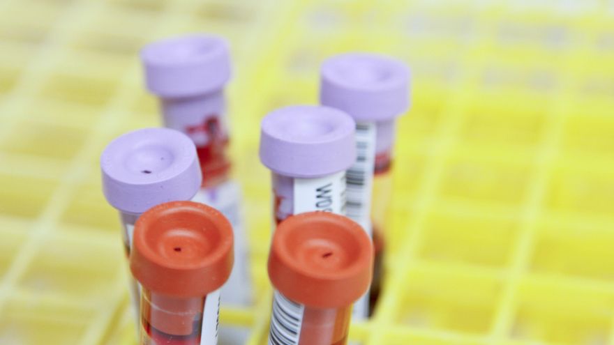 Un análisis de sangre podría reemplazar a las muestras en médula ósea para detectar leucemia