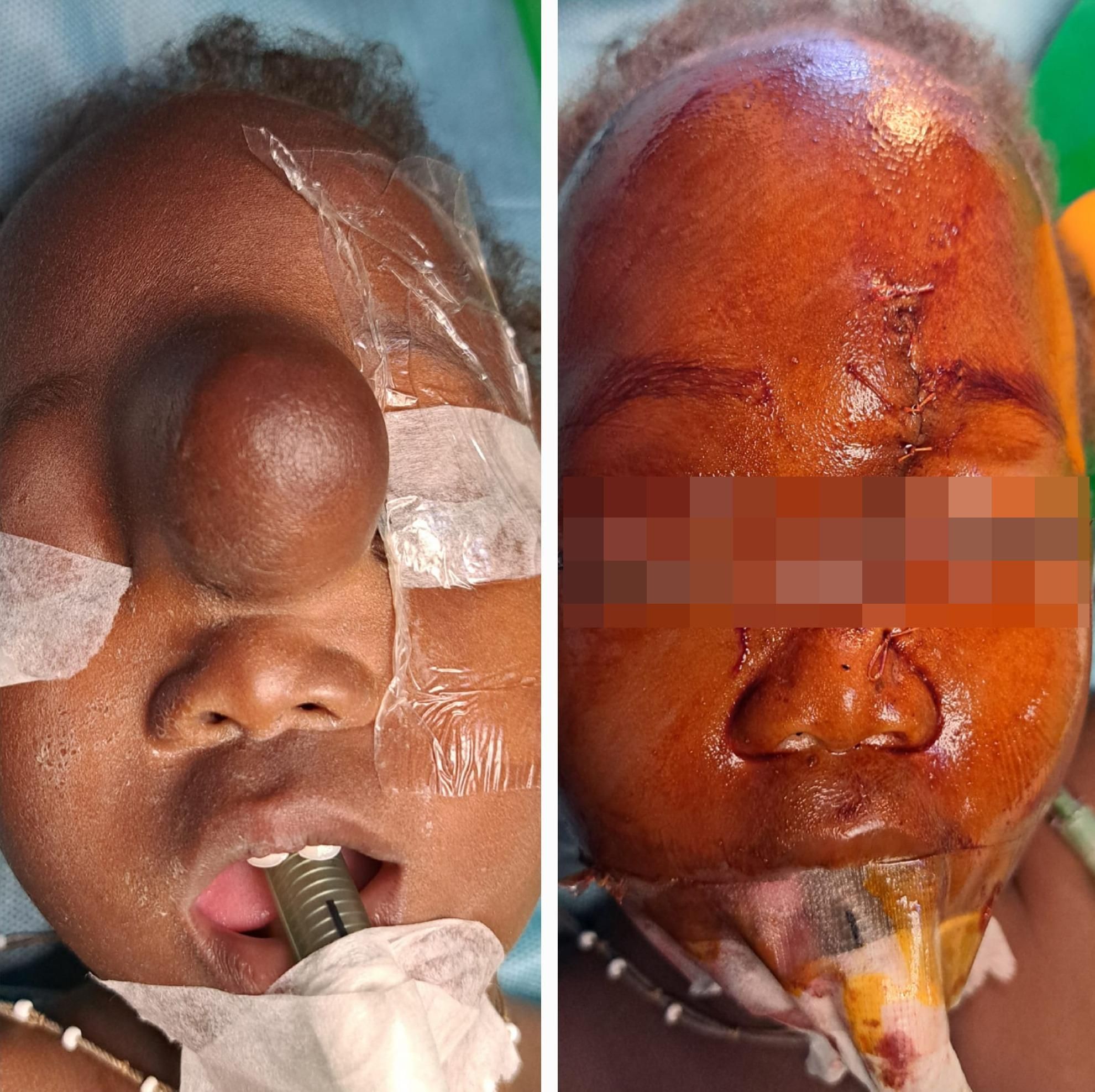 Un nen de 2 anys, que patia un glioma intracranial, després de ser sotmès a una extirpació i una cirurgia plàstica.